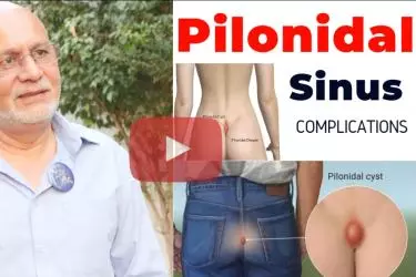 Best pilonidal sinus treatment in delhi